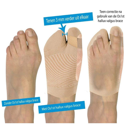 OS1ST HV3 Bunion Brace Sports Medicine, Large - XL