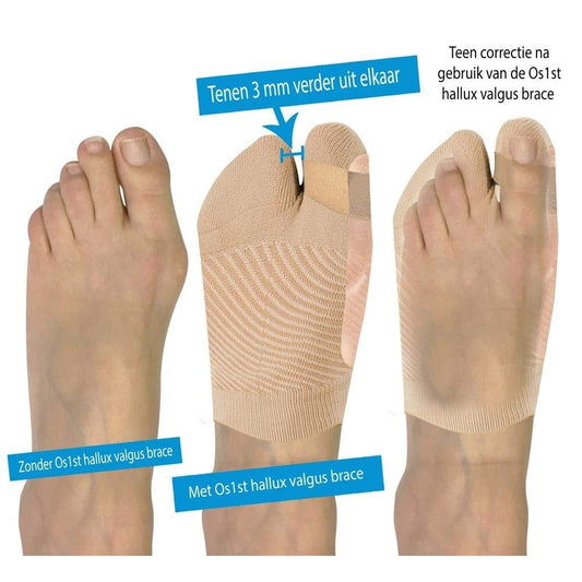 OS1ST HV3 Bunion Brace Sports Medicine, Large - XL